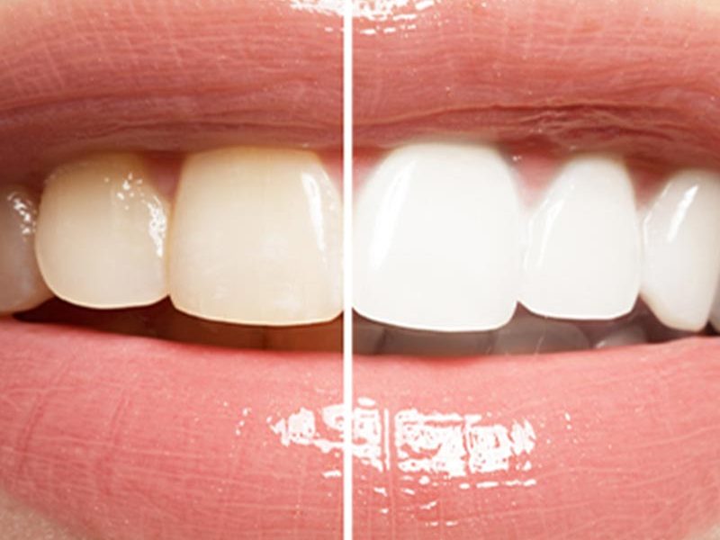 before and after tooth whitening comparison photo
