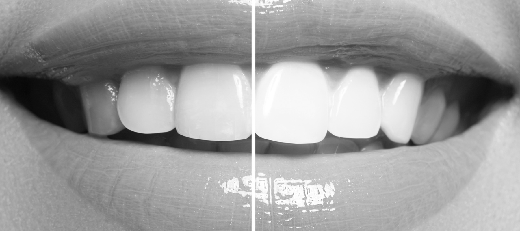 Why pola’s tooth whitening solutions are best for patient choice
