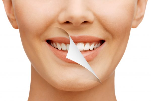 Educating patients about illegal tooth whitening is important to avoid harm
